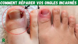 Comment réparer les Ongles incarnés rapidement et facilement [upl. by Rafat]