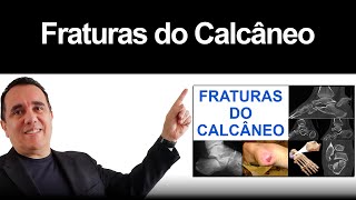 Fraturas do Calcâneo [upl. by Mears757]