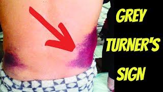 Grey Turners Sign amp Retroperitoneal Haemorrhage Explained  Doctor ODonovan [upl. by Nnylarak]