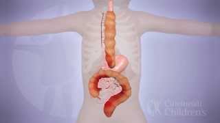 LongSegment Colonic Interposition for Esophageal Atresia 3D Animation [upl. by Ahsead66]