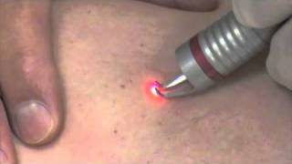 Ron Bush MD  Treating Spider Veins with diode laser [upl. by Risa618]