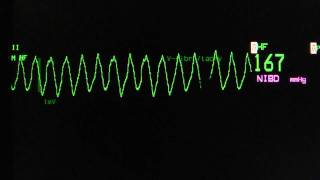 ventricular tachycardia  Torsade de Pointes on an ECG heart monitor [upl. by Kung]