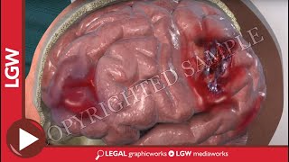 Traumatic brain injury TBI 3D animation [upl. by Enitsirk]