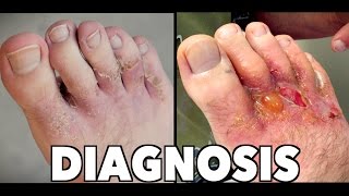 HORRIBLE FOOT RASH Final Diagnosis amp 2 Week Follow Up  Dr Paul [upl. by Eikcim]