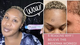 5 REASONS WHY I BELIEVE MEDERMA WORKED SCAR UPDATE MEDERMA RESULTS BEFORE amp AFTER NIJAH J [upl. by Aikahs]