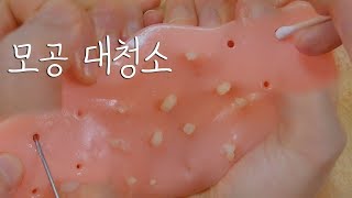 피지 짜고 귀이개로 모공 속 마무리｜여드름 장난감｜ASMR [upl. by Notwal411]