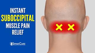 How to Fix Suboccipital Pain in 30 SECONDS Base of Skull Pain Relief [upl. by Aiket]