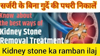 Kidney stone remove without surgery दवा से गुर्दे की पथरी निकालें Kidney stone homeopathmedicine [upl. by Hayifas]