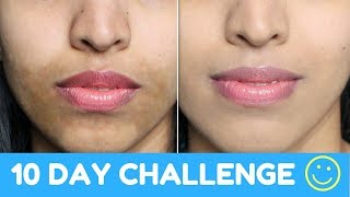 How To Get Even Skin Tone Naturally Powerful Home Remedy Hyper Pigmentation [upl. by Llorrad87]