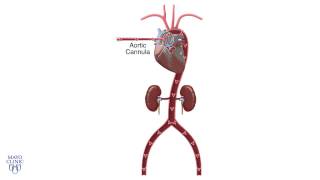 Central Cannulation and VenoArterial ECMO  Mayo Clinic [upl. by Halet919]