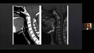 Radiological anatomy of Larynx and Hypopharynx Dr Kajari Bhattacharya [upl. by Trutko]