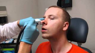 Septoplasty Nasal Splint Packing removal and nose cleaning [upl. by Dickenson813]