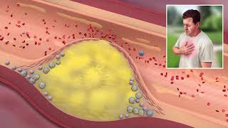 Atherosclerosis Pathophysiology USMLE [upl. by Eromle595]