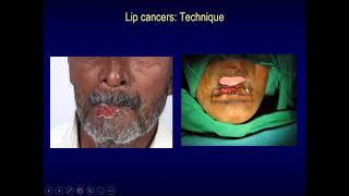 Brachytherapy in Head and Neck CancerProf Ashwini Budrukkar [upl. by Okia293]