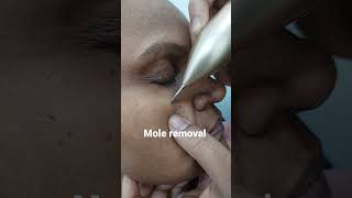 mole removal by cautery pen [upl. by Yrolg]