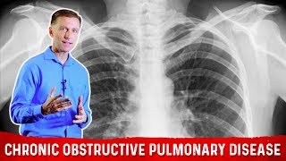 Intermittent Fasting and Chronic Obstructive Pulmonary Disease COPD – DrBerg [upl. by Katz152]