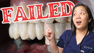 Doctor Reveals Top 3 Reasons Dental Implants Fail [upl. by Ahseetal]