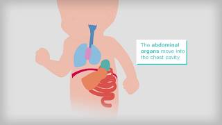 What is congenital diaphragmatic hernia [upl. by Aaren540]