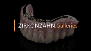 Prettau® Bridges on titanium bases and a reinforcement bar  ZirkonzahnGalleries [upl. by Emilia756]