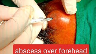 abscess over forehead  infected cyst over forehead  incision n drainage youtube dr doctor [upl. by Liggett344]