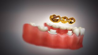 Gold Dental Bridge and Crown  Fixed Bridge  Fixed Dental Replacement [upl. by Nylaroc829]