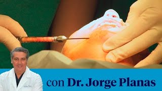 ¿Qué es el una lipoestructura facial [upl. by Rheims]