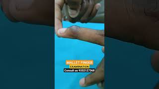 Mallet finger Examinationhand physiotherapy pain advice finger movement thumb stiffness [upl. by Callie]