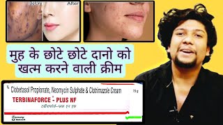 Terbinaforce Plus NF Cream uses in Hindi  Best Antifungal  चेहरे पर छोटे छोटे दाने निकलना [upl. by Hopkins]