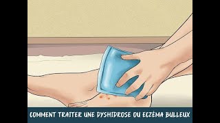 Comment traiter une dyshidrose ou eczéma bulleux [upl. by Keefe941]