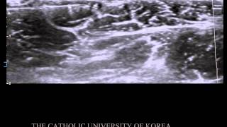 Ultrasound guided Lateral Femoral Cutaneous Nerve Block [upl. by Adnileb]