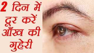 आंख की गुहेरी दूर करने के घरेलु उपाय  How to get rid of a Stye  Eye Care  Hordeolum  Boldsky [upl. by Hardej]