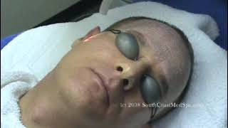 Laser Skin Resurfacing Active Fx [upl. by Lanny973]