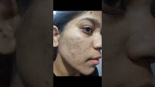 2 month complete tretinoin cream 0025 face tretinoin skincare tretinoincream darkspots face [upl. by Cirdet203]