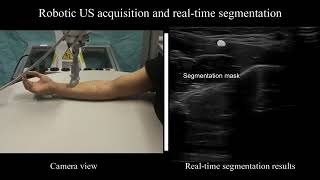 Towards Autonomous Atlasbased Ultrasound Acquisitions in Presence of Articulated Motion [upl. by Anirol]