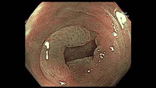 Colonoscopy Appendicular orifice SSA detection requires careful exam [upl. by Dieball]