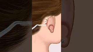 ASMR Infected ear piercing removal animation P1 animation asmr satisfying viral shorts [upl. by Enyaht]