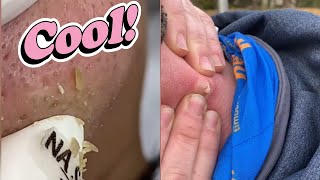 Satisfying Pimple Pops Compilation  Relaxing Blackhead Removal  Skincare Satisfaction [upl. by Huebner]