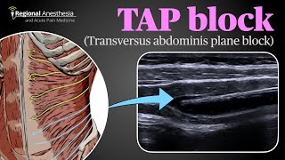 Ultrasound Guided Transversus Abdominis Plane TAP Block [upl. by Bushey]