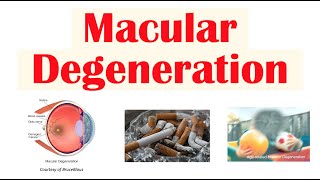 Macular Degeneration  Wet vs Dry  Risk Factors Pathophysiology Symptoms Diagnosis Treatment [upl. by Lurleen]