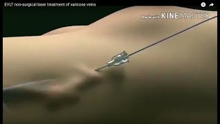 EVLT Laser Treatment for Varicose Veins The Future of Varicose Vein Treatment Animation Video [upl. by Akcirahs883]