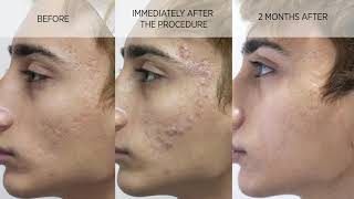 Acne scar subcision and filler [upl. by Eiuol]