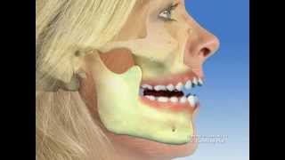 TMJ  Temporomandibular joint dysfunction [upl. by Lesslie]