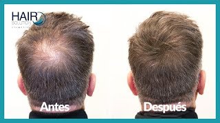 Fibras capilares Hair Solution  antes y después  Hair Fibers [upl. by Pfaff965]