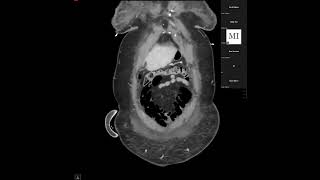 Abdominal Case Conference  442023 [upl. by Eelaras377]