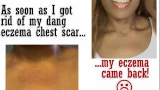 How To Get Rid of Eczema amp Scars Impatient Dieter New Effing Eczema Scar Series [upl. by Tadd]