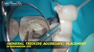 MINERAL trioxide aggregate MTA placement in perforation site endodontic treatment [upl. by Laurentium]