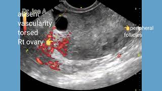 Torsion ovary sonography ultrasound and color Doppler video [upl. by Paz]