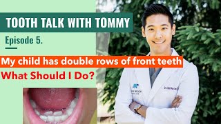 What Should Parents Do If the Childs New Front Teeth Are Coming in Behind Their Baby Teeth [upl. by Anoy216]