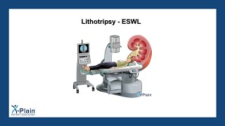 Lithotripsy  ESWL [upl. by Yssak]