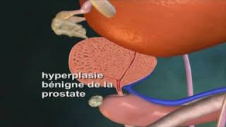 HYPERPLASIE BÉNIGNE DE LA PROSTATE [upl. by Weider]